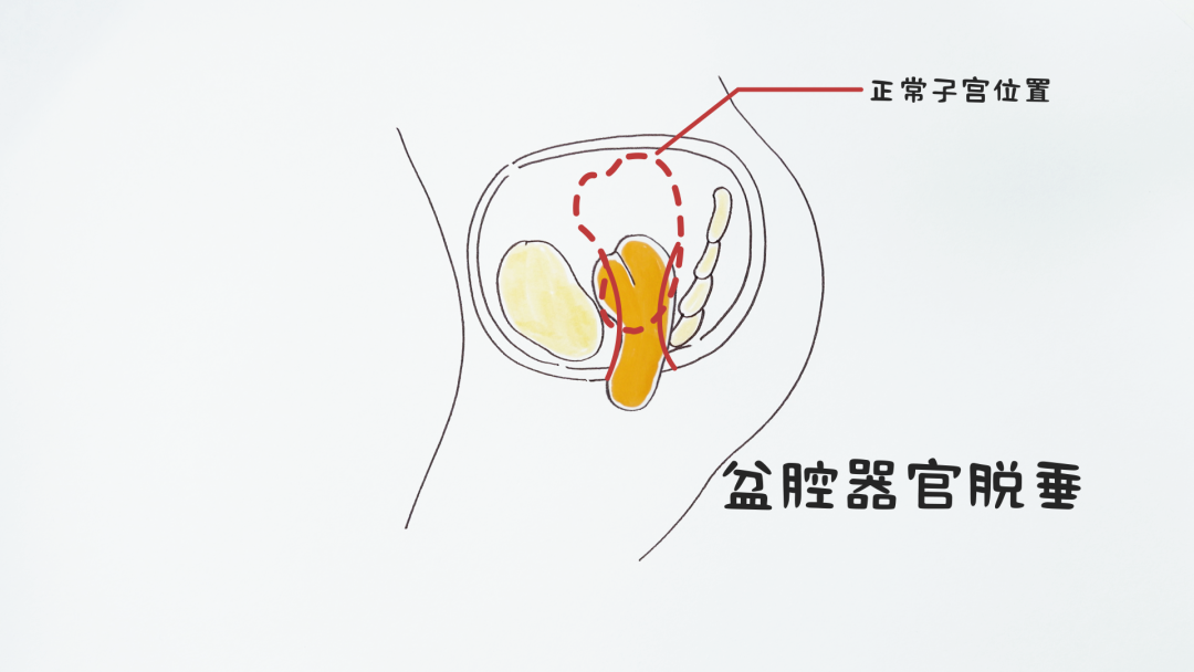 妈妈们42天检查做完,经常会听到医生说: "你是前壁膨出" "你是中度